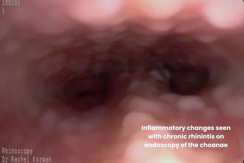 Endoscopic view inside the nasal passage showing inflamed tissue and narrowed airway consistent with chronic rhinitis.