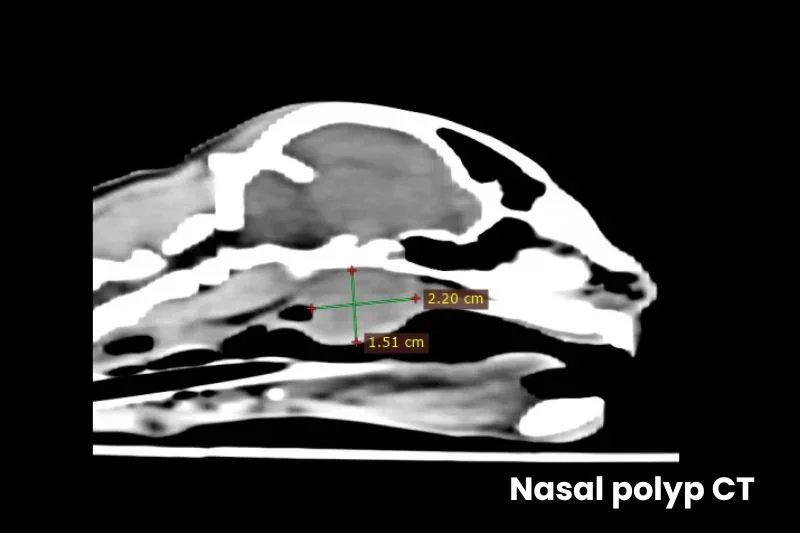 CT scan of the nasal cavity showing a soft tissue mass with measurement markers, consistent with a nasal polyp.