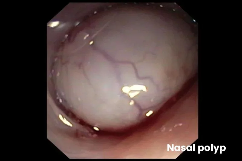 Endoscopic view of a smooth, pale, rounded nasal polyp filling the nasal passage.