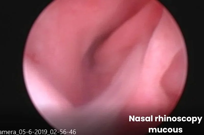 Endoscopic view of the nasal passage showing pink mucosal lining with visible mucus coating the surface.