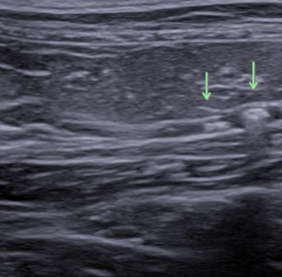 Feline kidney ultrasound showing subtle renal changes highlighted by arrows