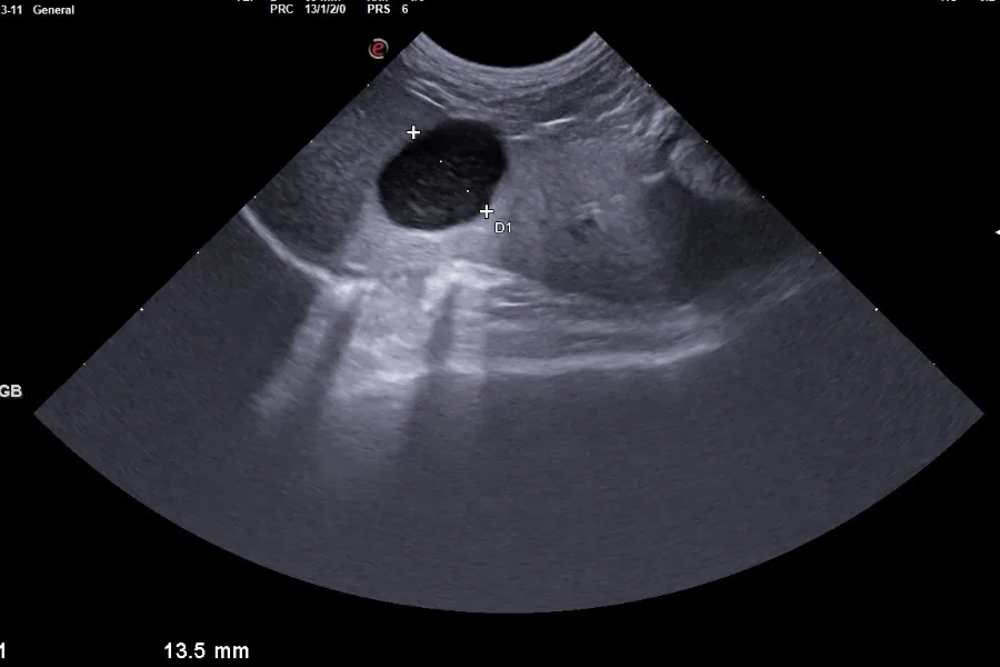 Ultrasound scan showing an internal fluid-filled structure with measurement calipers indicating 13.5 mm.